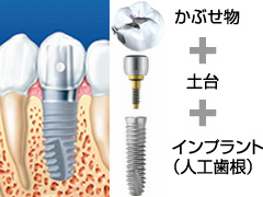 インプラントとは